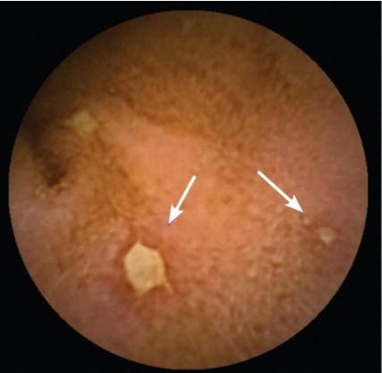 Έλκη λεπτού εντέρου σε Νόσο Crohn