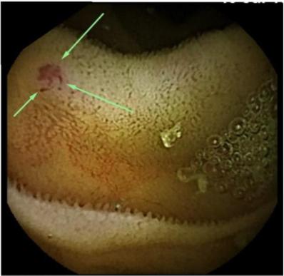 Αγγειδυσπλασία λεπτού εντέρου
