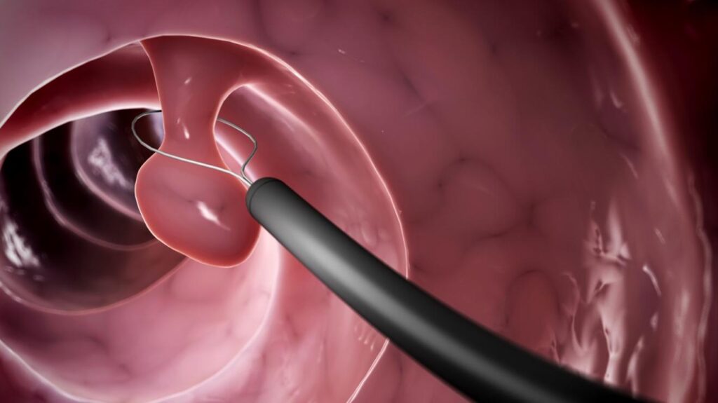 ΔΙΑΔΙΚΑΣΙΑ ΠΟΛΥΠΟΔΕΚΤΟΜΗΣ