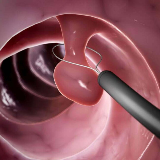 ΔΙΑΔΙΚΑΣΙΑ ΠΟΛΥΠΟΔΕΚΤΟΜΗΣ θεσσαλονίκη