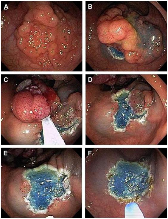 Διαδικασία Πολυποδεκτομής