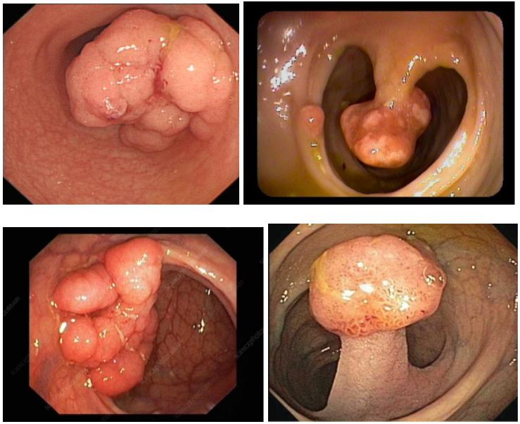 αδενωματώδεις πολύποδες παχέος εντέρου