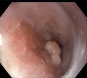 Ανάπτυξη αδενοκαρκινώμαπτος σε έδαφος οισοφάγου Barrett