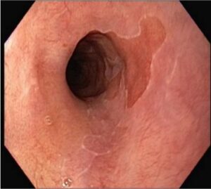 Γλωσσίδα Οισοφάγου Barrett