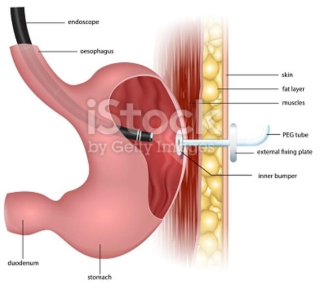 ΔΙΑΔΕΡΜΙΚΗ ΕΝΔΟΣΚΟΠΙΚΗ ΓΑΣΤΡΟΣΤΟΜΙΑ (PEG)