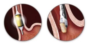 ΘΕΡΑΠΕΙΑ ΜΕ ΡΑΔΙΟΣΥΧΝΟΤΗΤΕΣ ΟΙΣΟΦΑΓΟΥ BARRETT